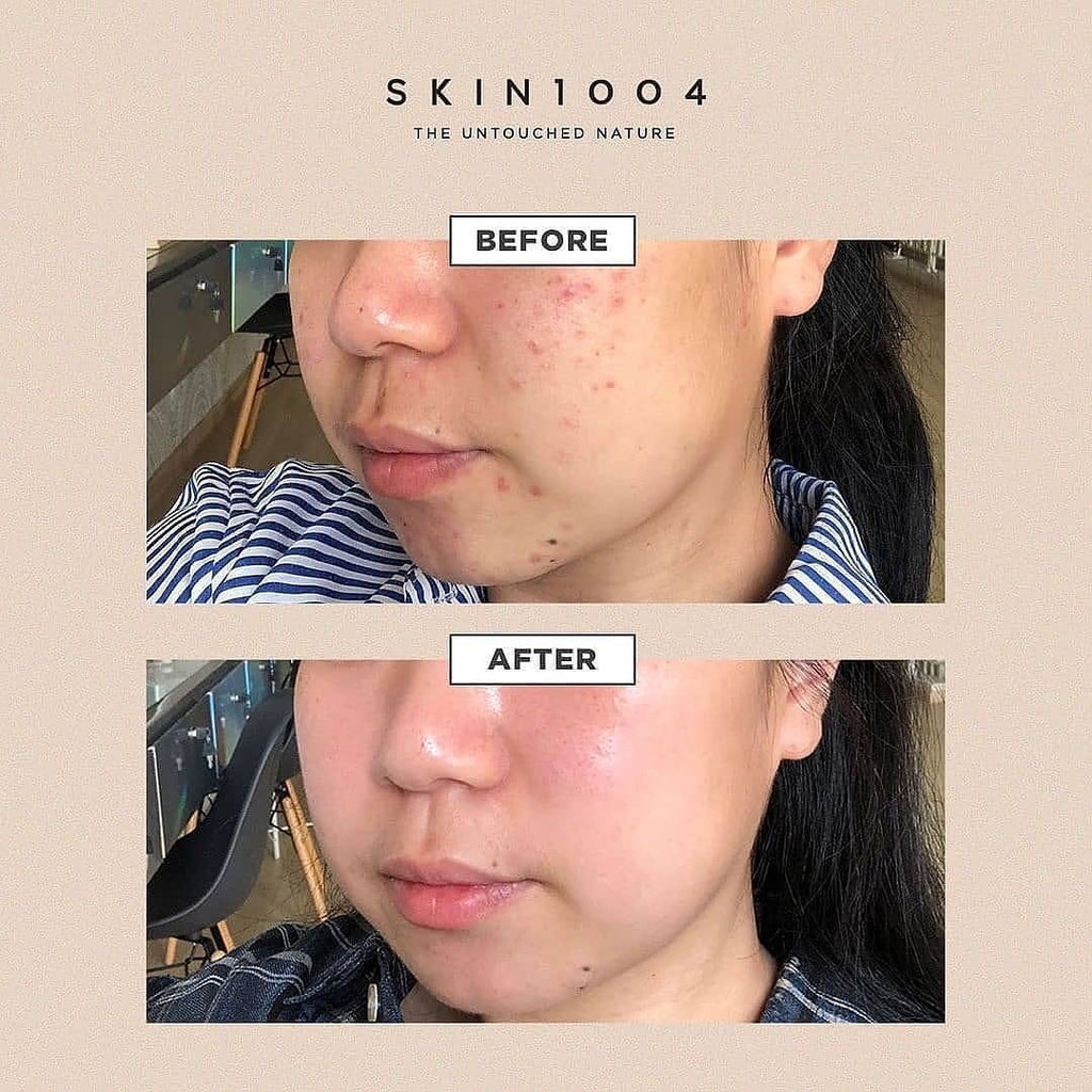 現貨|SKIN1004 馬達加斯加積雪草精華 Madagascar Centella Asiatica 100 Ampoule 100ml