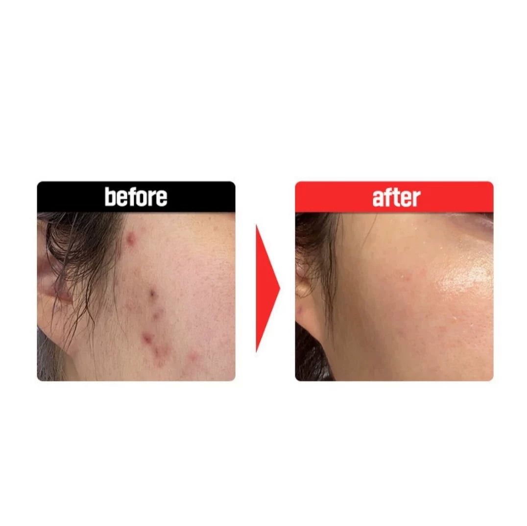 韩国Fation梵蒂爱积雪草净痘修复精华镇定泛红淡化痘印敏感肌正品