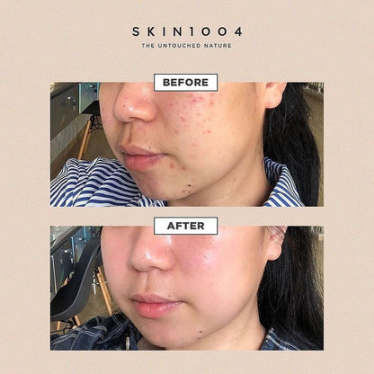現貨｜SKIN1004 馬達加斯加積雪草精華 Madagascar Centella Asiatica 100 Ampoule 100ml